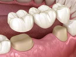 Bridge Partial / Fixed Dental